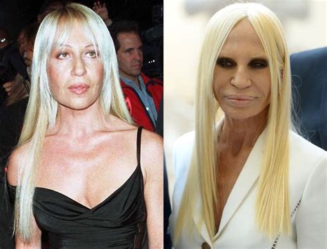 donatello versace|donatella versace before and after surgery.